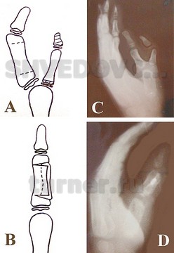 Устранение радиальной полидактилии с использованием кожно-сухожильно – костного лоскута дополнительного сегмента.