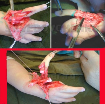 Этапы выполнения операции поллицизации – выделение тыльных пальцевых вен и ладонных сосудисто-нервных пучков, отделение межкостных мышц, отсечение эпифиза пястной кости