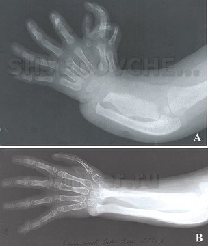 Долихофалангеальная форма трехфалангизма большого пальца кисти в сочетании с полидактилией и лучевой косорукостью. А- рентгенограмма предплечья и кисти до лечения. В – рентгенограмма после устранения косорукости, полидактилии и трехфалангизма.