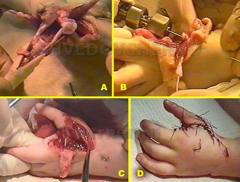 Этап операции поллицизации, перенос и фиксация пальца на месте первого луча: а/ заключитыльный этап выделения переносимого сегмента, палец соединен с кистью сосудисто-нервными пучками и сухожилиями сгибателей, в/ этап проведения осевой спицы после резекции пястной кости, c,d/ вид пальца после фиксации и ушивания ран.