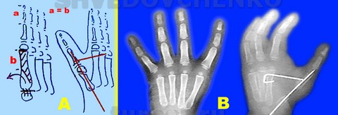 Схема резекции пястной кости при операции поллицизации: а/ величина резекции пястной кости /а/ равняется величине необходимого укорочения пальца/б/,   в/ рентгенограммы кисти до и после хирургического вмешательства.