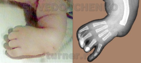 Фото и рентгенограмма предплечья и кисти больного Н.,10 мес., с врожденной лучевой косорукостью и аплазией 1 пальца кисти до начала лечения.