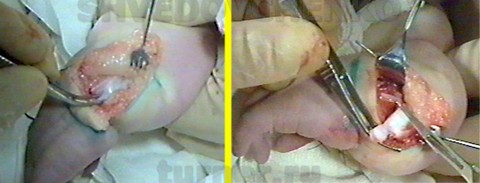 Выделение головки локтевой кости и резекция капсулы локтезапястного сустава при центрации кисти  у больного Н., при центрации кисти на имеющейся локтевой кости.