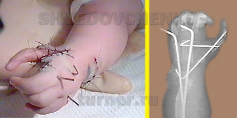 Фото и рентгенограмма кисти после поллицизации 2-го пальца с одновременным устранением косорукости.
